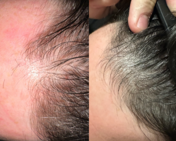 Hair restoration results