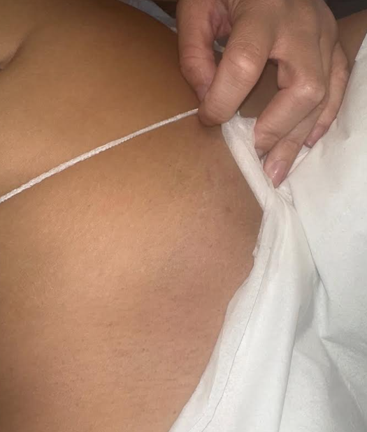 Laser hair removal results - bikini