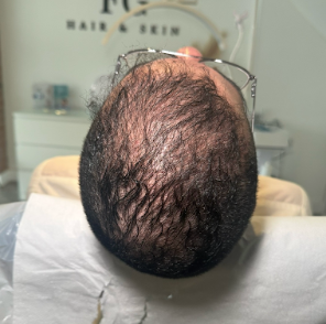 Hair restoration