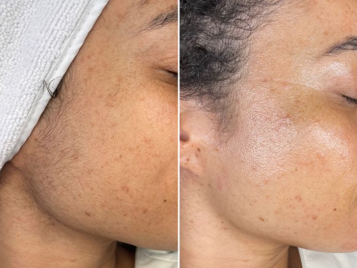 Before and After - Dull to bright skin