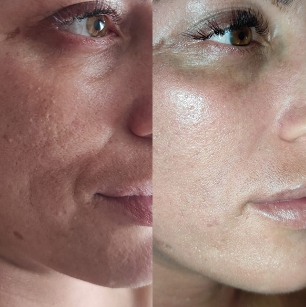 Before and after skin texture treatment