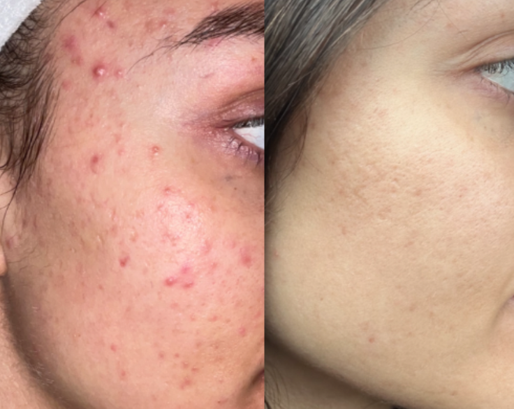 Skin texture and tone before and after