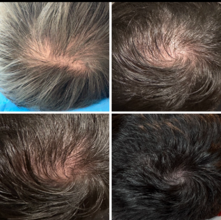 Hair restoration results