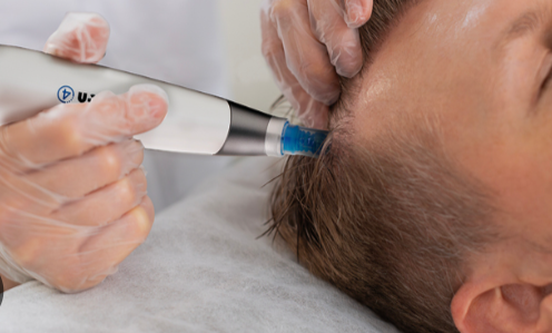 Dermapen 4 Scalp Microneedling