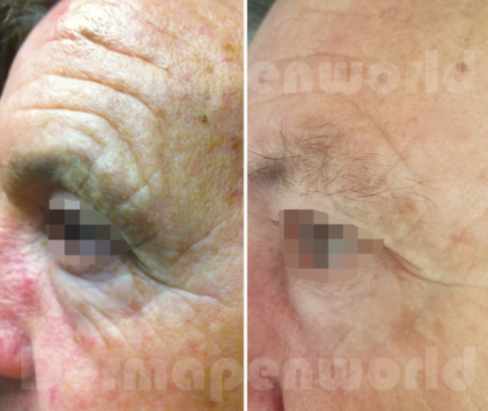 Before and after sun damage treatment