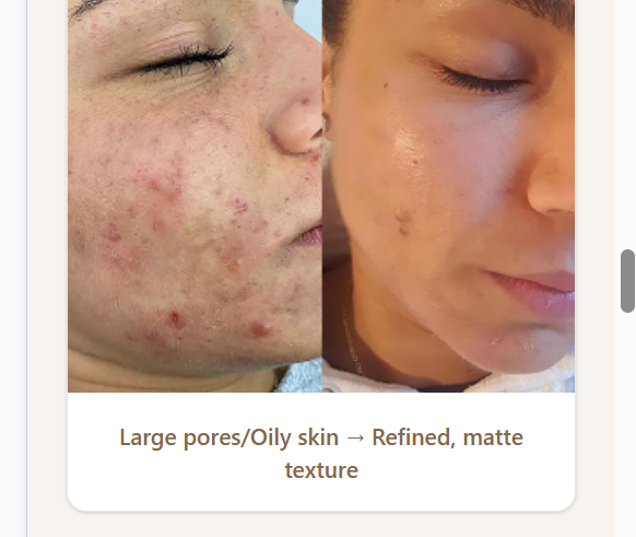 Before and after pigmentation, scarring and acne treatment