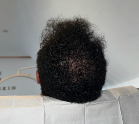 Hair restoration