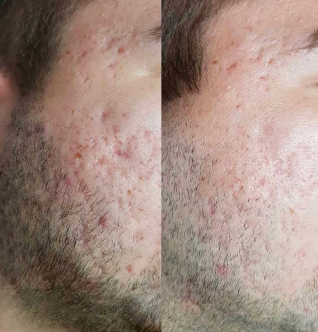 Acne Scarring