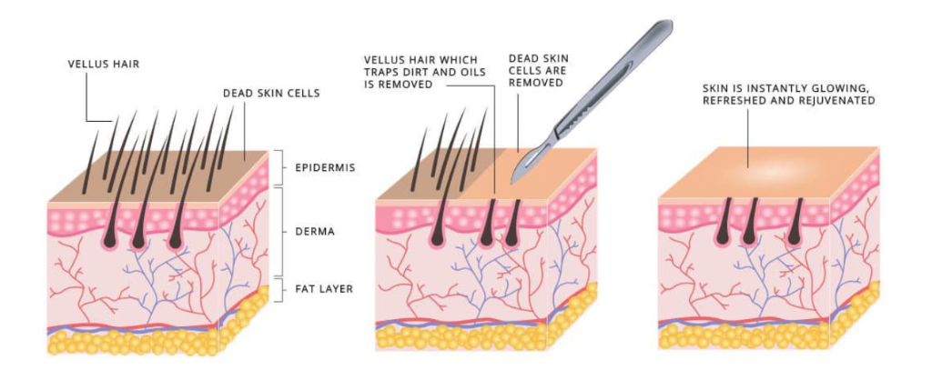 Dermaplaning process diagram