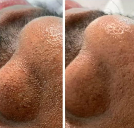Fine lines and pigmentation improvement