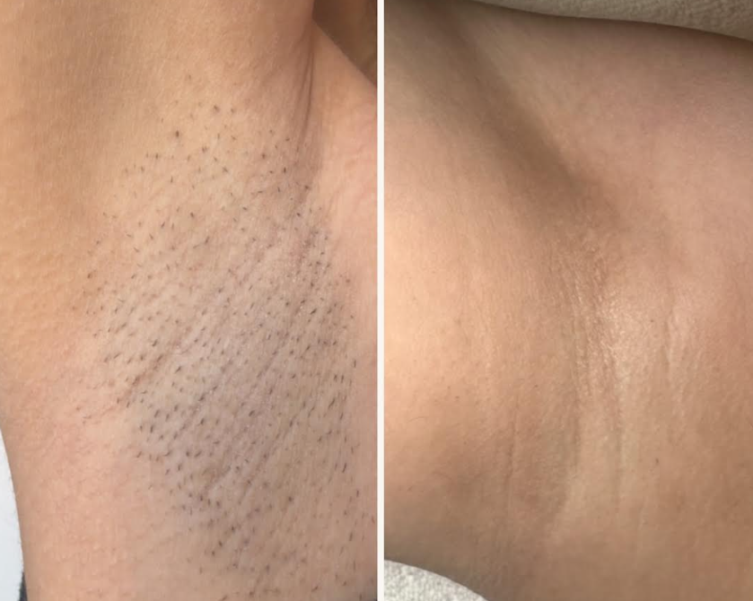 Laser hair removal results - underarms