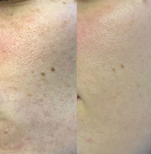 Before and after pigmentation treatment