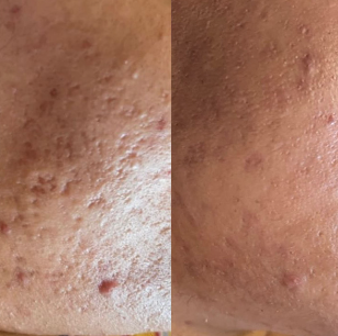 Before and after acne treatment