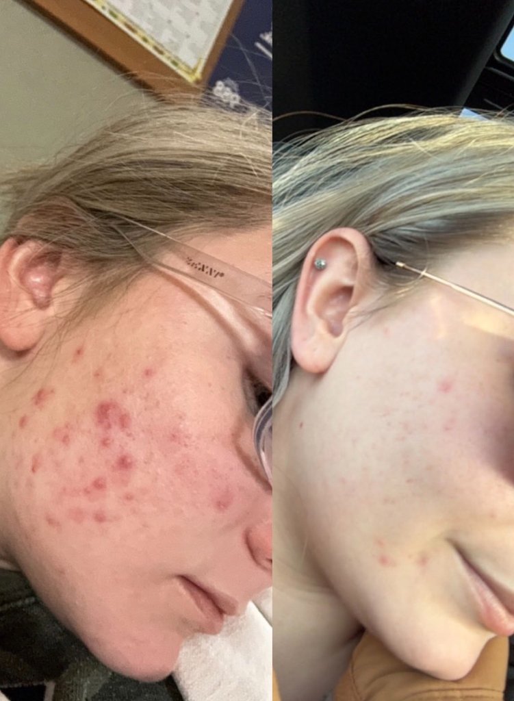 Before and after result 2