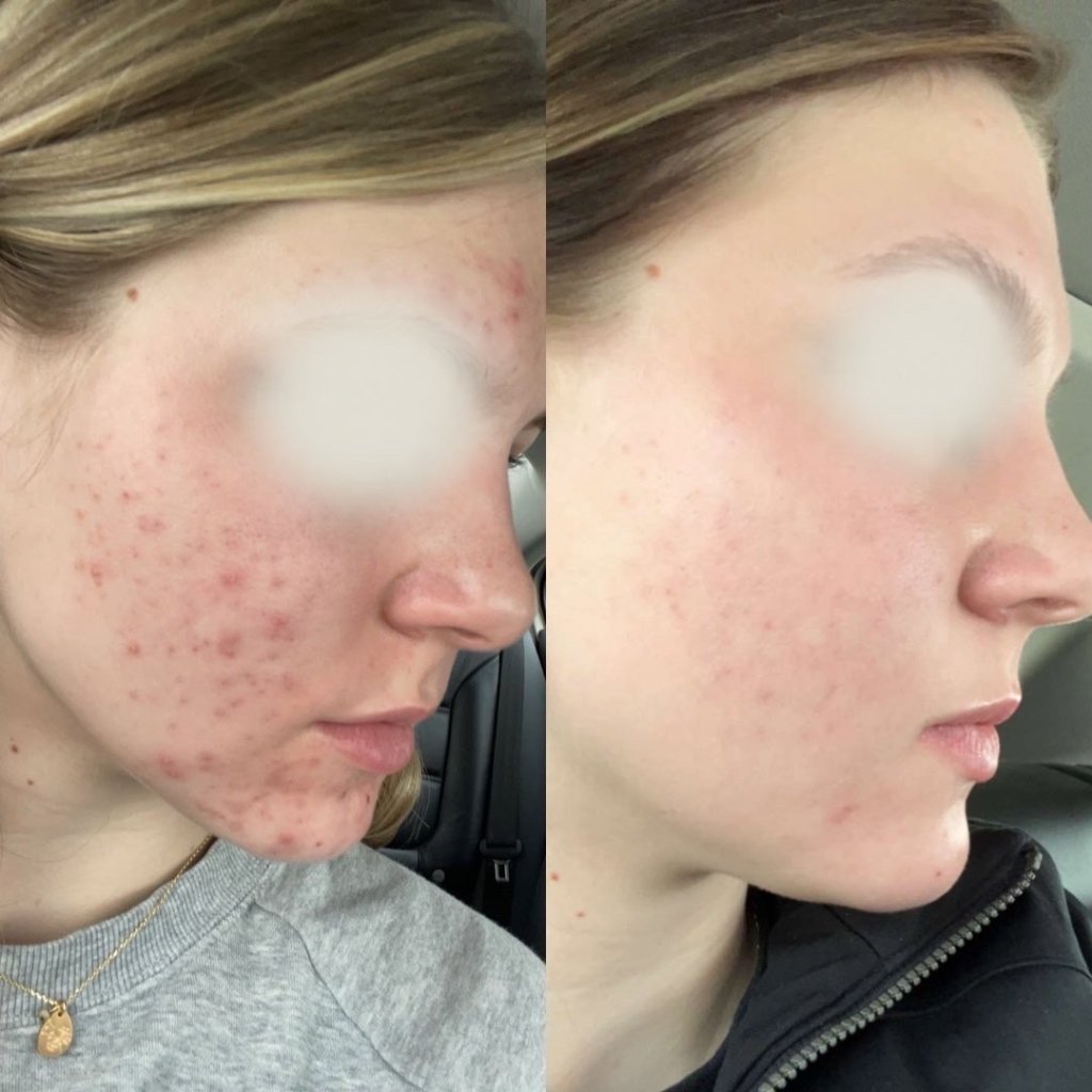 Before and after result 5