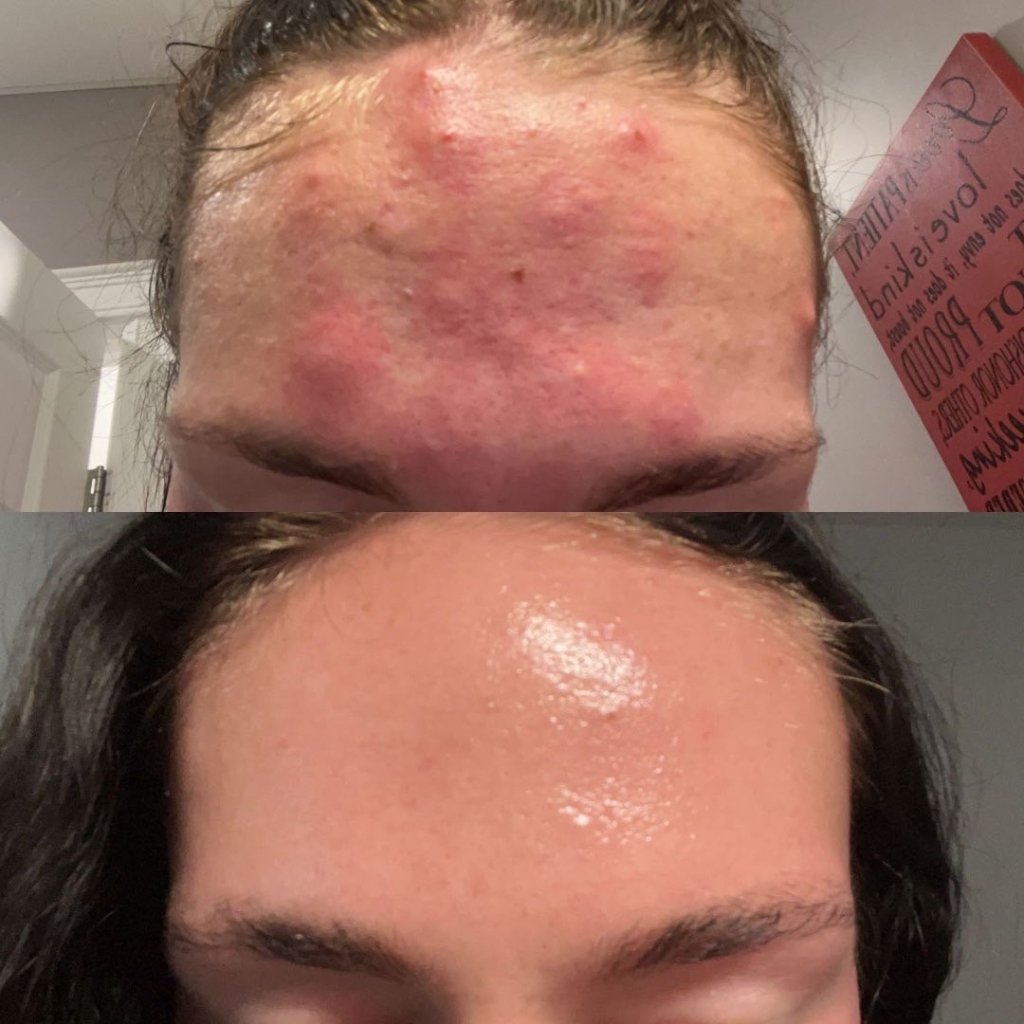 Before and after result 13
