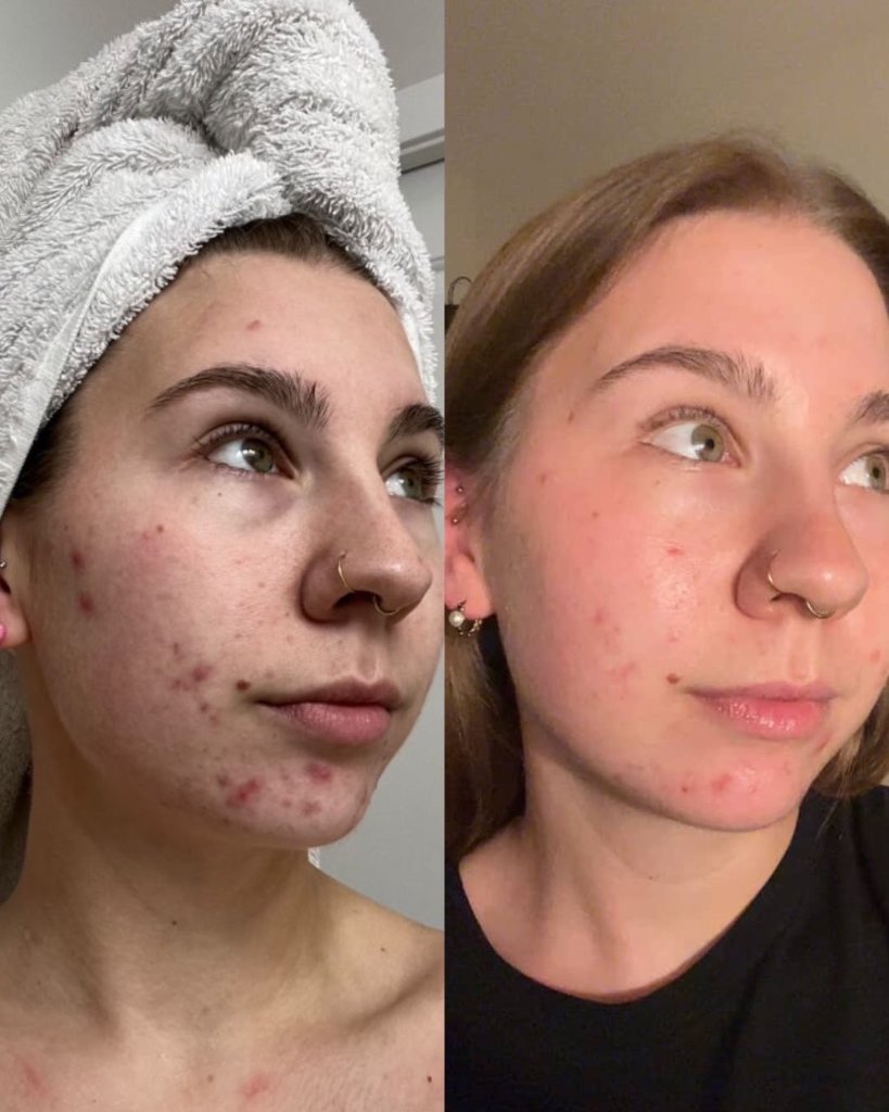 Before and after result 15