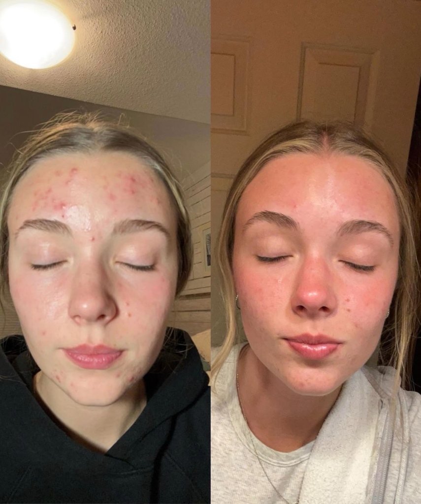 Before and after result 14