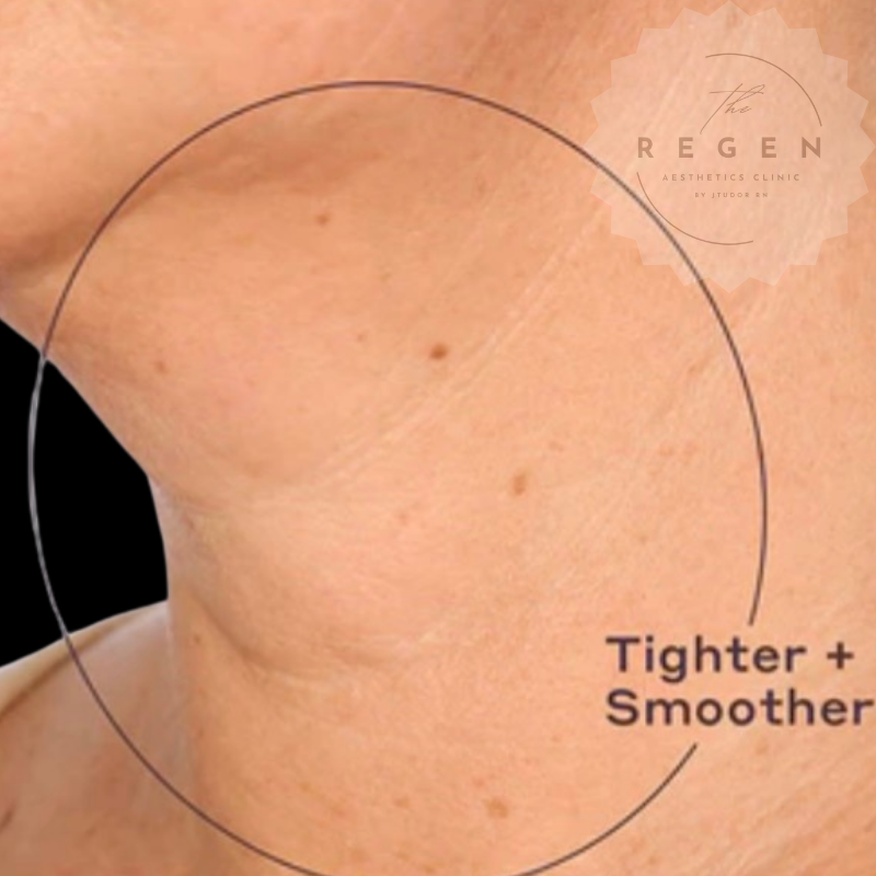 After Profhilo — Neck Skin Booster results — ReGen Aesthetics Clinic South Wales