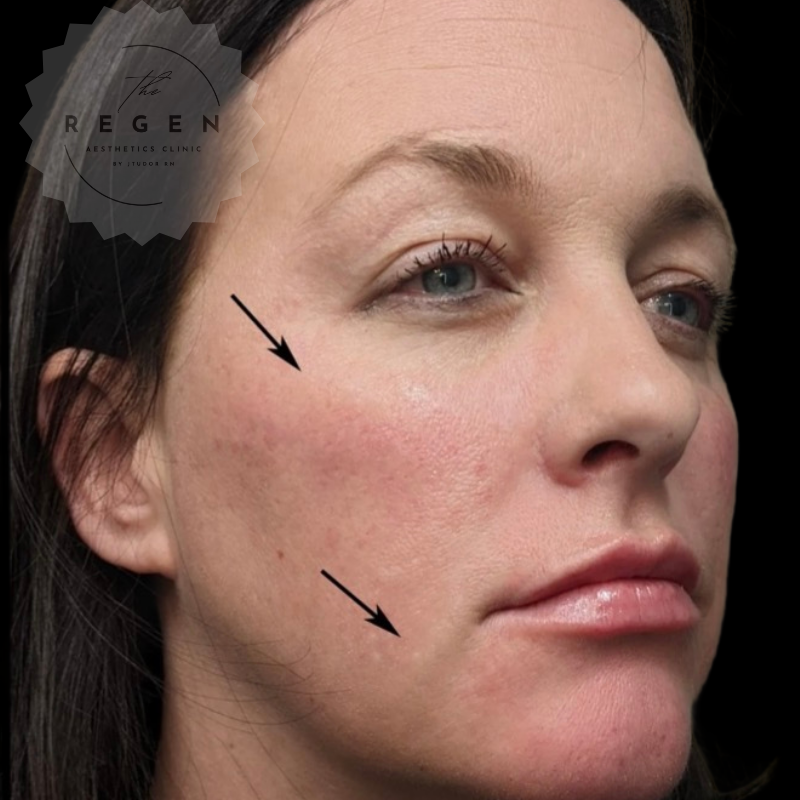After Dermal Fillers — Non-Surgical Face Lift results — ReGen Aesthetics Clinic South Wales