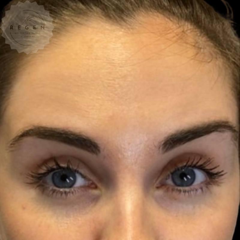 After Anti-Wrinkle Injections — Forehead Lines results — ReGen Aesthetics Clinic South Wales