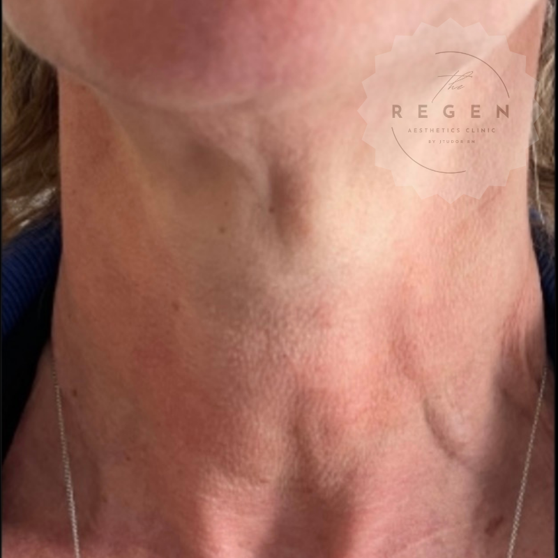 After Polynucleotides — Neck Rejuvenation results — ReGen Aesthetics Clinic South Wales