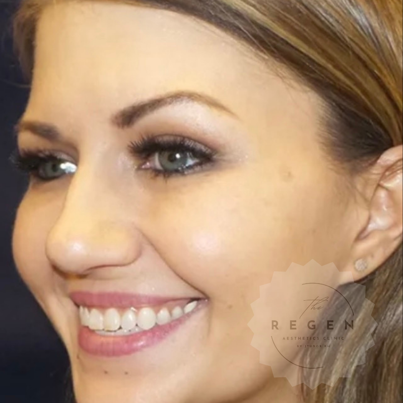After Anti-Wrinkle Injections — Crow's Feet results — ReGen Aesthetics Clinic South Wales