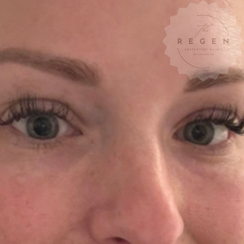 After Skin Hybrid Biostimulator Rejuvenation — Under Eyes results — ReGen Aesthetics Clinic South Wales