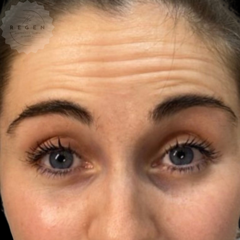 Before Anti-Wrinkle Injections — Forehead Lines — ReGen Aesthetics Clinic Merthyr Tydfil