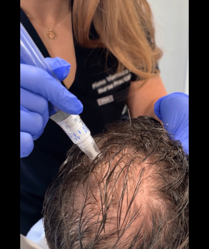 Dermal filler treatment at ReGen Aesthetics Clinic Merthyr Tydfil