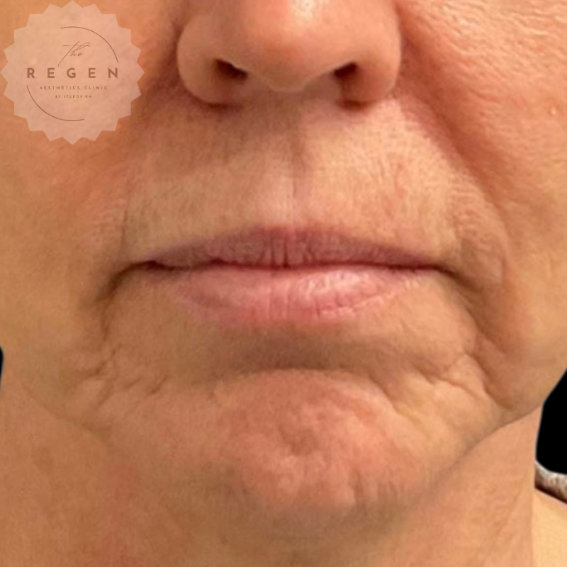 Before Perioral Rejuvenation — Polynucleotides, Toxin & Fillers — ReGen Aesthetics Clinic Merthyr Tydfil