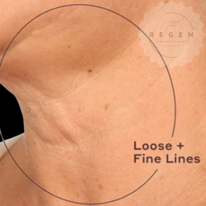 Before Profhilo — Neck Skin Booster — ReGen Aesthetics Clinic Merthyr Tydfil