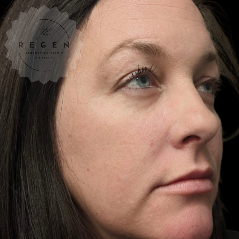 Before Dermal Fillers — Non-Surgical Face Lift — ReGen Aesthetics Clinic Merthyr Tydfil