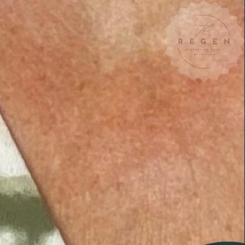 After Polynucleotides — Décolletage Rejuvenation results — ReGen Aesthetics Clinic South Wales