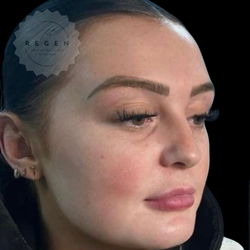 Before Dermal Fillers — Full Face Profiling — ReGen Aesthetics Clinic Merthyr Tydfil