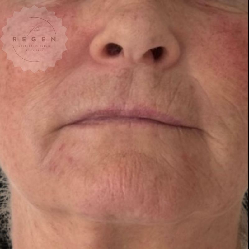 After Skin Hybrid Biostimulator Rejuvenation — Face results — ReGen Aesthetics Clinic South Wales