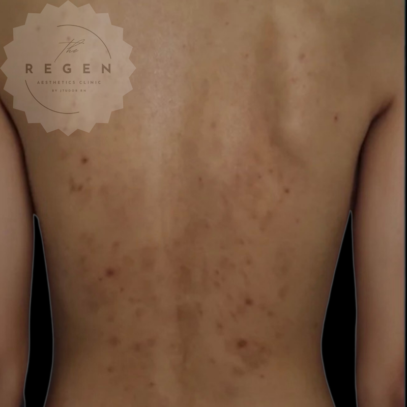 Before BioRePeel — Upper & Lower Back — ReGen Aesthetics Clinic Merthyr Tydfil