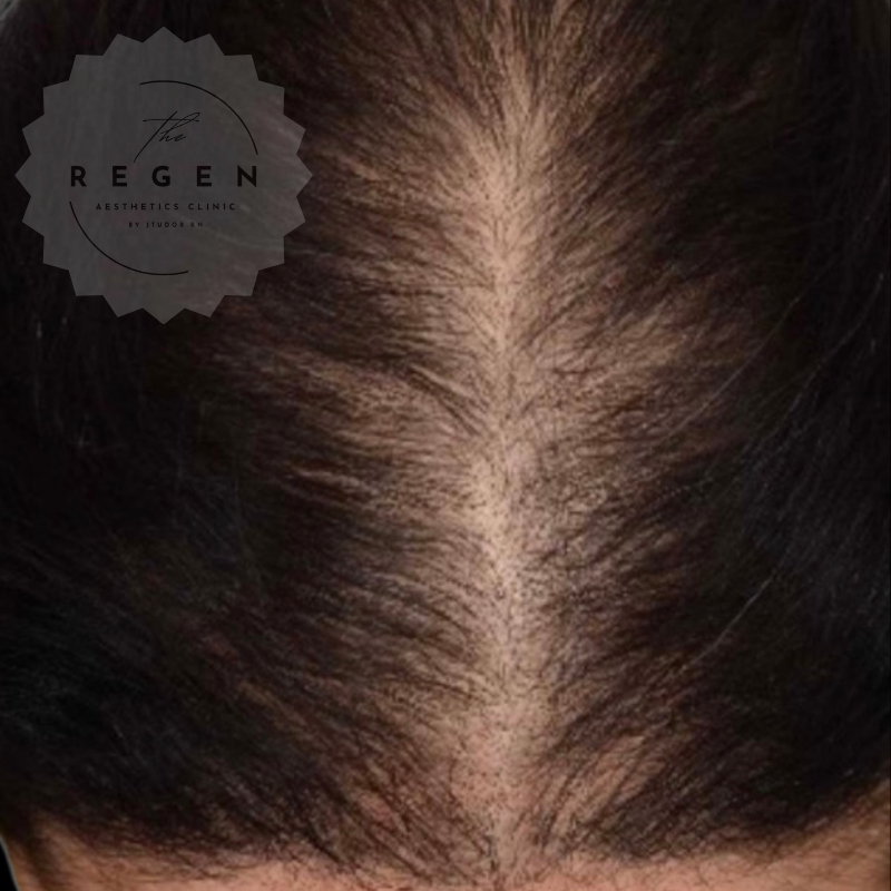 After PRP Scalp Hair Restoration — Standard Zone results — ReGen Aesthetics Clinic South Wales