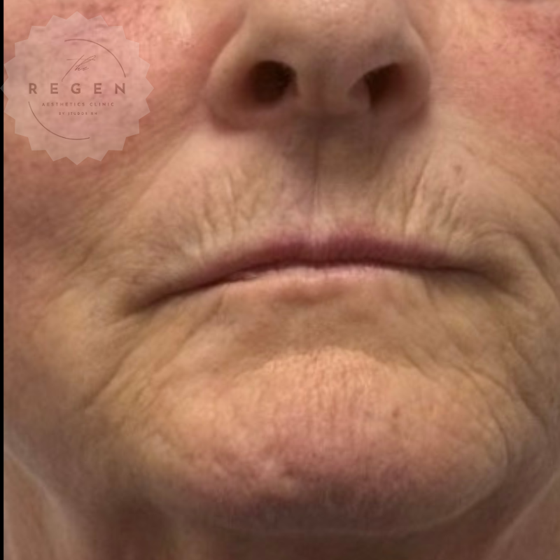 Before Skin Hybrid Biostimulator Rejuvenation — Face — ReGen Aesthetics Clinic Merthyr Tydfil