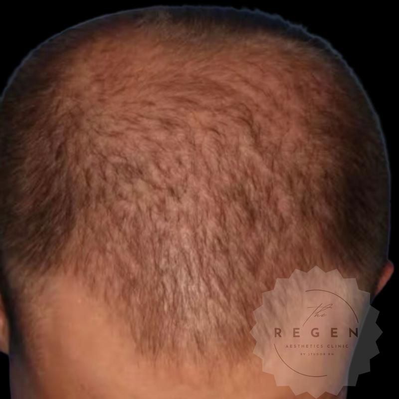 Before PRP Scalp Hair Restoration — Full Scalp — ReGen Aesthetics Clinic Merthyr Tydfil