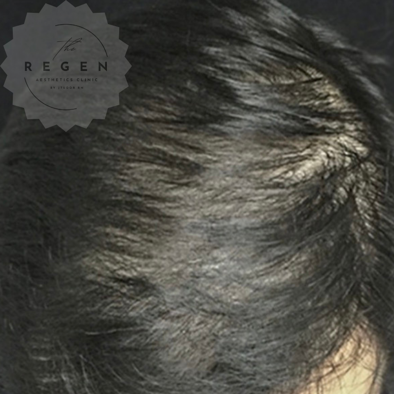 After Scalp Mesotherapy + Exosomes — Hair Restoration results — ReGen Aesthetics Clinic South Wales
