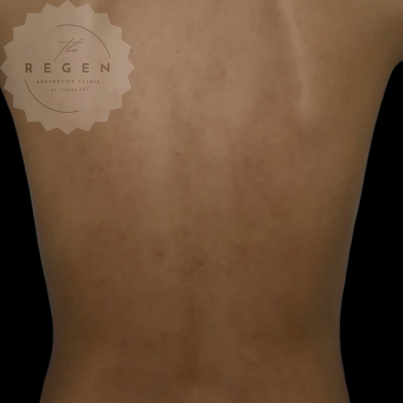 After BioRePeel — Upper & Lower Back results — ReGen Aesthetics Clinic South Wales