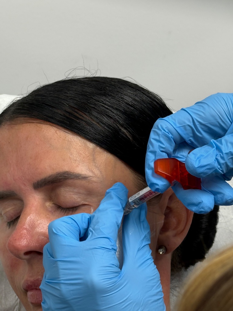 Microneedling collagen treatment at ReGen Aesthetics Clinic South Wales