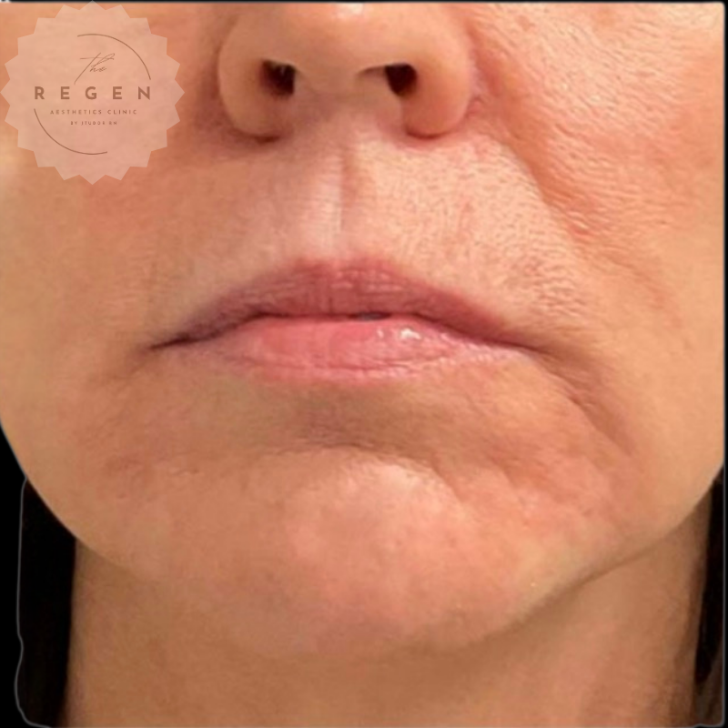 After Perioral Rejuvenation — Polynucleotides, Toxin & Fillers results — ReGen Aesthetics Clinic South Wales