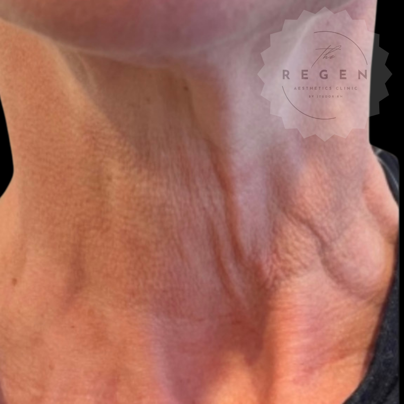 Before Polynucleotides — Neck Rejuvenation — ReGen Aesthetics Clinic Merthyr Tydfil