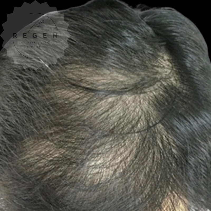 Before Scalp Mesotherapy + Exosomes — Hair Restoration — ReGen Aesthetics Clinic Merthyr Tydfil