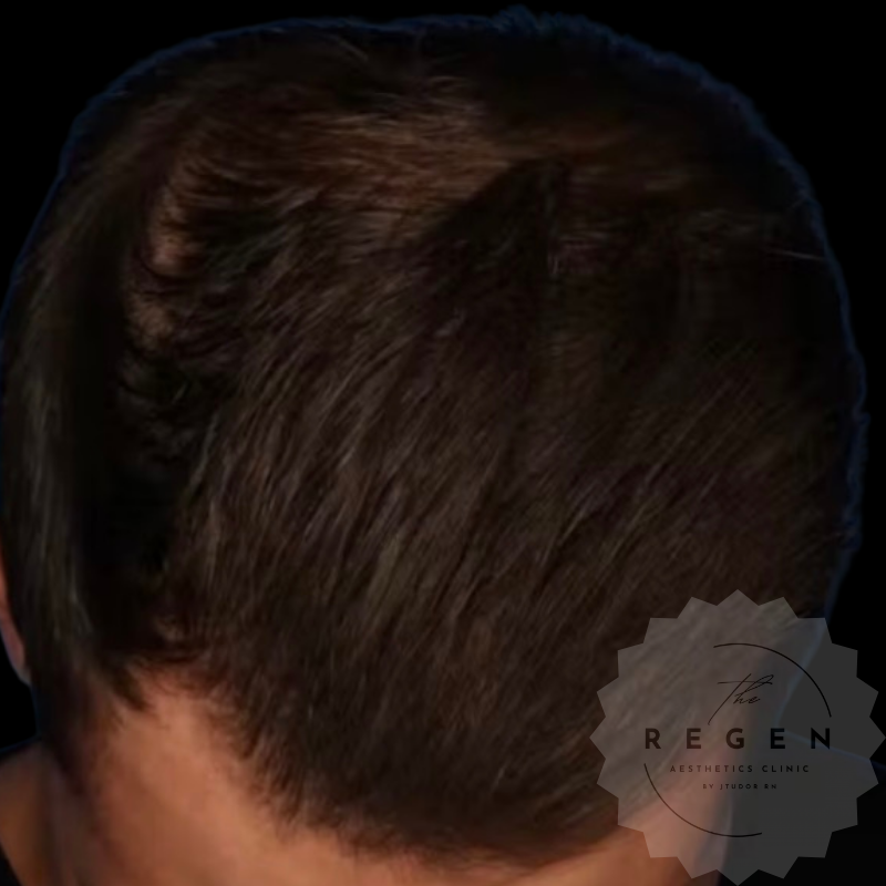 After PRP Scalp Hair Restoration — Full Scalp results — ReGen Aesthetics Clinic South Wales
