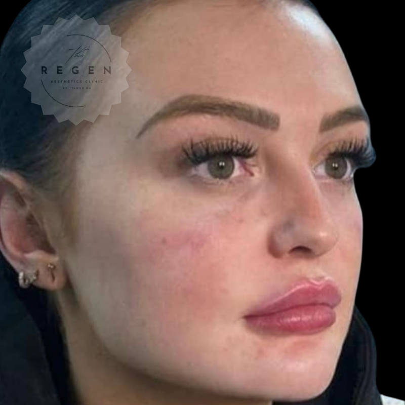 After Dermal Fillers — Full Face Profiling results — ReGen Aesthetics Clinic South Wales