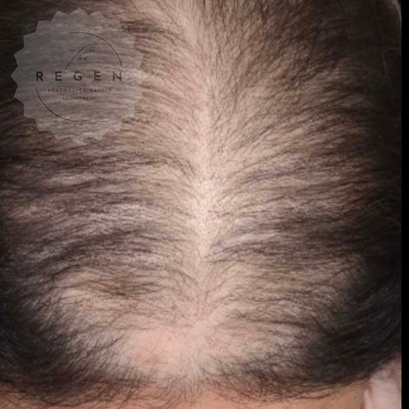 Before PRP Scalp Hair Restoration — Standard Zone — ReGen Aesthetics Clinic Merthyr Tydfil