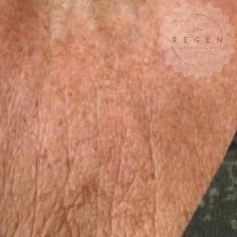 Before Polynucleotides — Décolletage Rejuvenation — ReGen Aesthetics Clinic Merthyr Tydfil